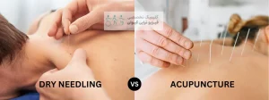 طب سوزنی خشک در تهرانسر؛ کاربردها، مزایا و عوارض 4 طب سوزنی