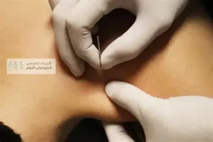 طب سوزنی خشک در تهرانسر؛ کاربردها، مزایا و عوارض 3 طب سوزنی خشک