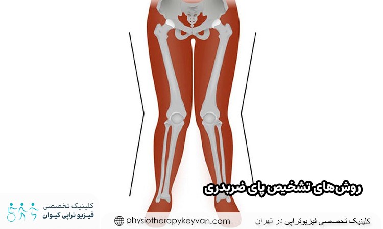 روش‌ های درمان پای ضربدری