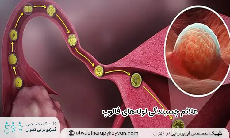 عوارض فیزیوتراپی رحم