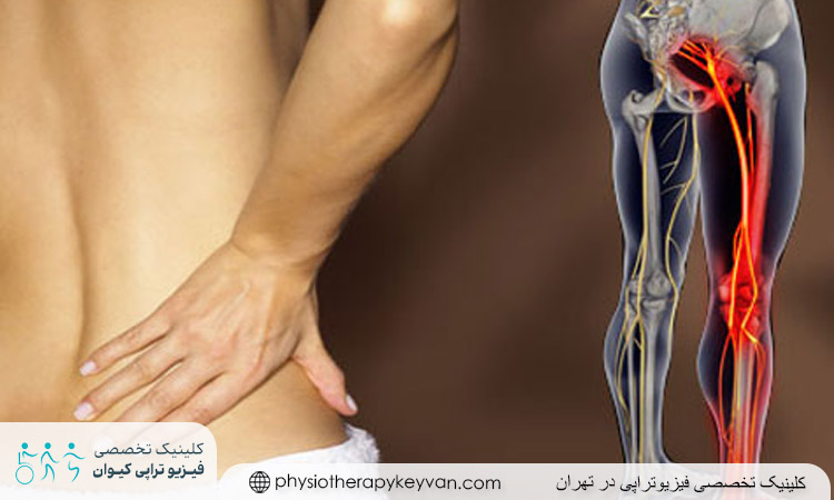 درد سیاتیک چیست و چگونه به‌ وجود می‌آید؟