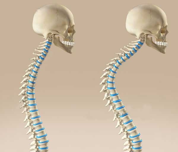 قوز پشت چیست و چه علائمی دارد؟
