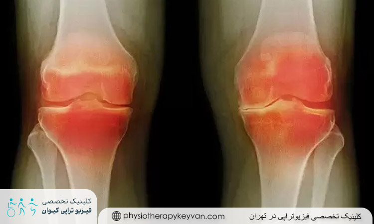 روش ‌های درمانی برای ساییدگی کشکک زانو