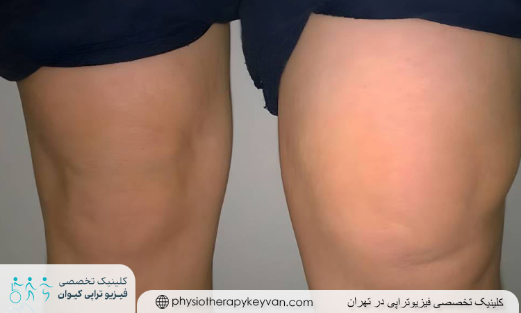 آیا آب آوردن زانو خطرناک است؟