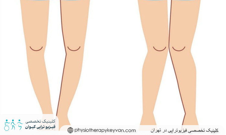 تفاوت پای پرانتزی و ضربدری چیست؟ 1 پای پرانتزی و ضربدری