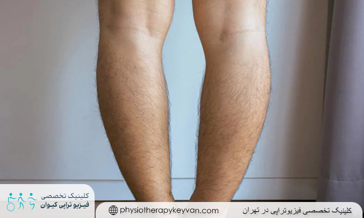 تفاوت پای پرانتزی و ضربدری چیست؟ 2 پای ضربدری