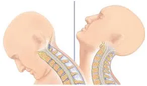 فیزیوتراپی بعد از جراحی دیسک گردن