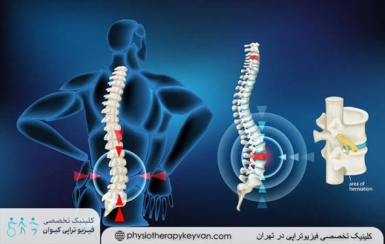 چه نوع کوهنوردی برای دیسک کمر ایمن تر است؟