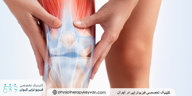 درمان پارگی تاندون زانو بدون جراحی