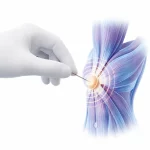 طب سوزنی خشک