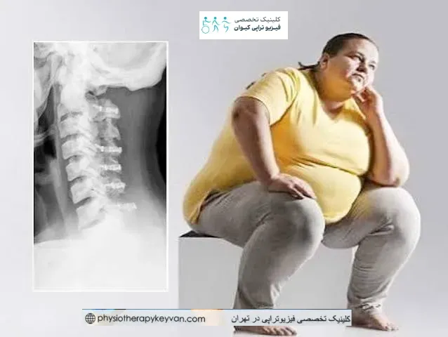 اضافه وزن و جراحی ستون فقرات | فیزیوتراپی قبل و بعد از عمل 6 کنترل وزن بعد از جراحی ستون فقرات با فیزیوتراپی