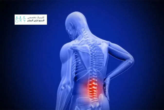 سندروم مفاصل فاست کمر 7 اقدامات پیشگیرانه و مراقبت های ارگونومیک برای سندروم مفاصل فاست کمر