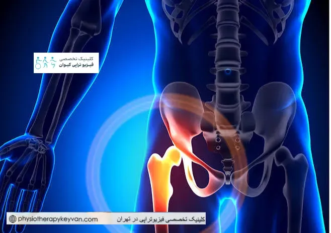 علت های درد کشاله ران 2 علل شایع درد کشاله ران راست