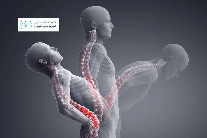 سندروم مفاصل فاست کمر 4 روش های معاینه تخصصی و ارزیابی بیو مکانیکی بیماری مفاصل فاست کمر
