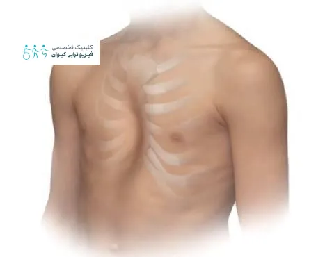 فرورفتگی دنده