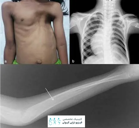 فرورفتگی دنده | نشانه، تشخیص و راهنمای کامل درمان 3 مهم ترین علائم و نشانه های بالینی فرورفتگی دنده