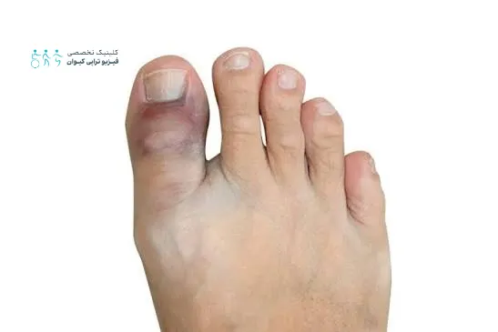 ضرب دیدگی انگشت پا | علائم، علل آسیب و راه درمان 4 علائم هشدار دهنده و زمان مراجعه اورژانسی به پزشک هنگام ضرب دیدن انگشت های پا