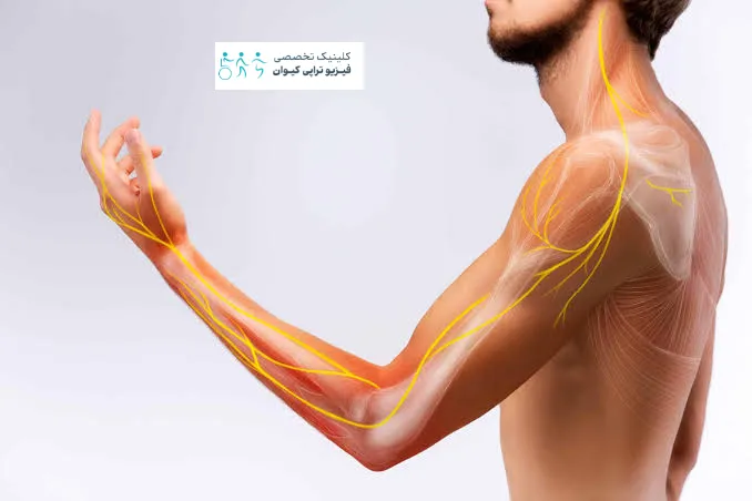 مهم ترین علت های درد بازو + روش درمان و فیزیوتراپی 2 علت درد ماهیچه بازو در بخش های مختلف